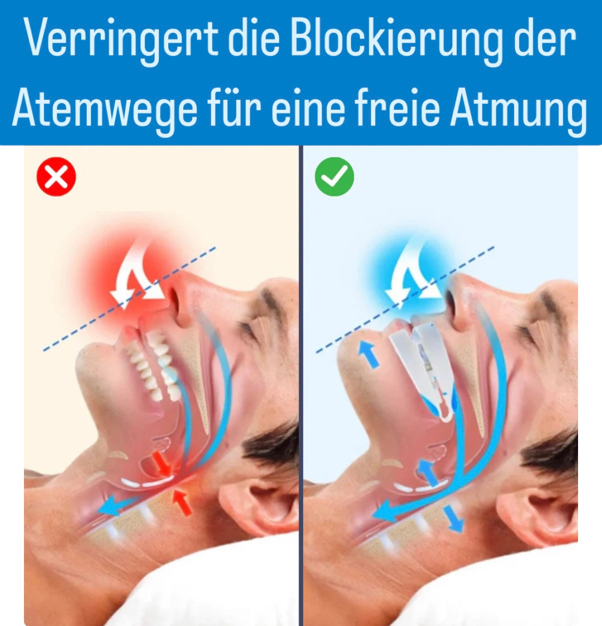 Anti-Schnarch-Schiene